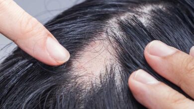 100% Organic Baldness Treatment Male Pattern Frontal Bald Spot-On Head
