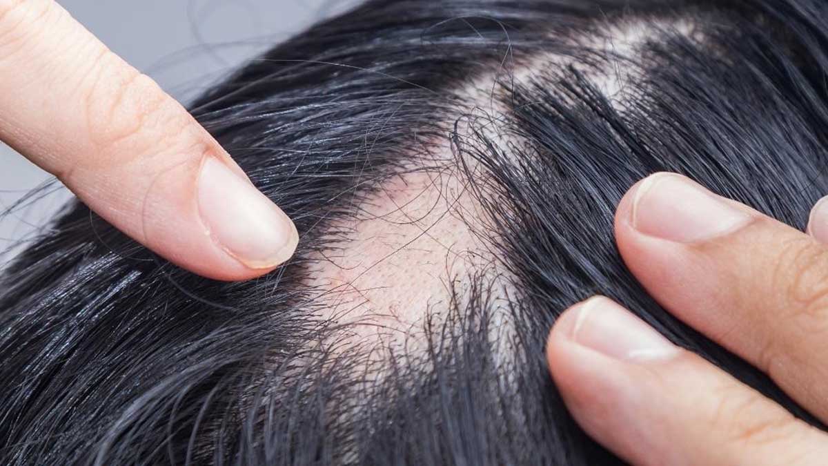 100% Organic Baldness Treatment Male Pattern Frontal Bald Spot-On Head