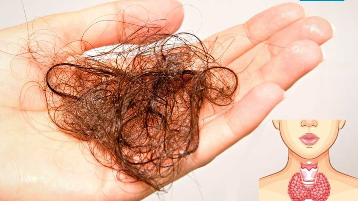 Thyroid Hair Loss 10 Powerful Ways to Stop Thyroid Hair Loss Male and Female