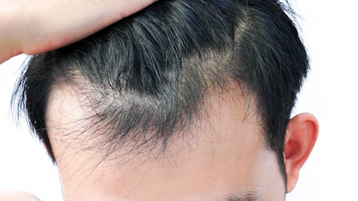 With Bonus Tip: Reverse Receding Hairline and Regrow Hair for Men